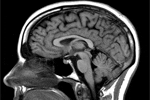 brain injury