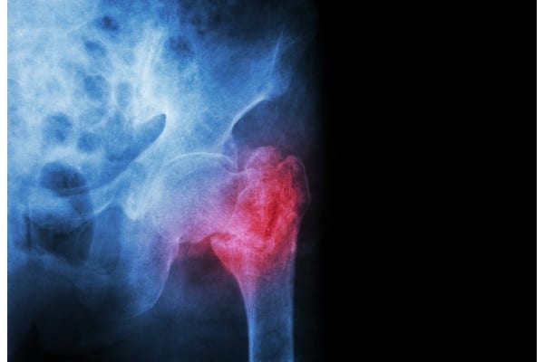 Hip Fracture Injuries