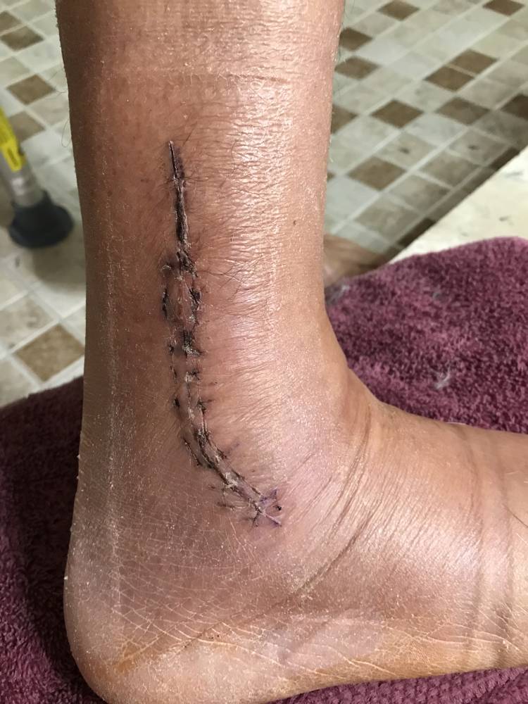 Stitches Ruptured Achilles Pain Medical Boot Achilles Tendon