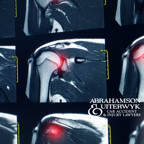 what is the average payout for a rotator cuff injury